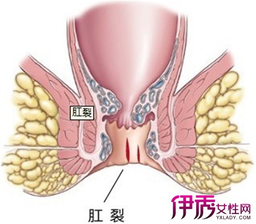 最新肛裂治疗方法的研究与应用进展